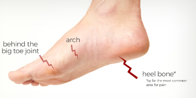 Plantar fasciitis is a common foot