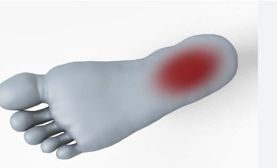 Plantar fasciitis is a common foot